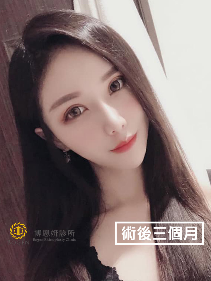 雙眼皮重修與提眼瞼肌矯正手術,提眼瞼肌矯正,博恩妍